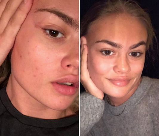 This Vitamin Drink is the Miracle Cure to Bad Skin and Breakouts